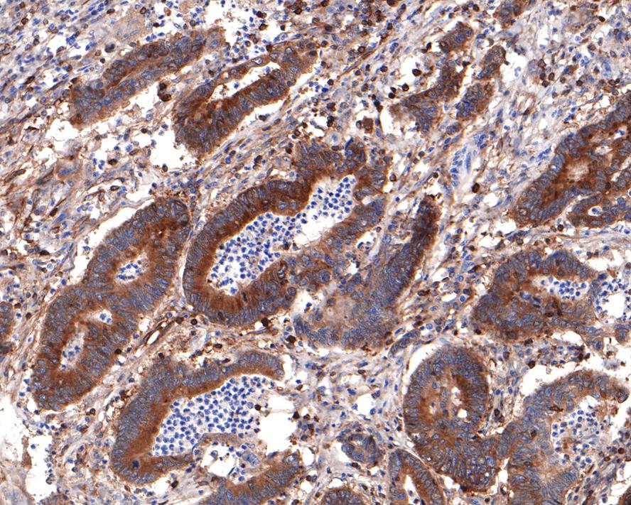 Immunohistochemical analysis of paraffin-embedded human colon carcinoma tissue with Rabbit anti-BIN1 antibody (HA721001) at 1/400 dilution.<br />
<br />
The section was pre-treated using heat mediated antigen retrieval with sodium citrate buffer (pH 6.0) for 2 minutes. The tissues were blocked in 1% BSA for 20 minutes at room temperature, washed with ddH2O and PBS, and then probed with the primary antibody (HA721001) at 1/400 dilution for 1 hour at room temperature. The detection was performed using an HRP conjugated compact polymer system. DAB was used as the chromogen. Tissues were counterstained with hematoxylin and mounted with DPX.