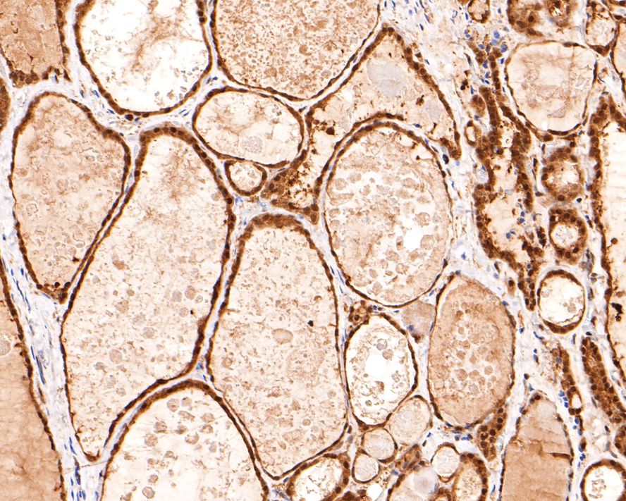 Immunohistochemical analysis of paraffin-embedded human thyroid tissue with Rabbit anti-Ube2L3 antibody (HA721005) at 1/400 dilution.<br />
<br />
The section was pre-treated using heat mediated antigen retrieval with sodium citrate buffer (pH 6.0) for 2 minutes. The tissues were blocked in 1% BSA for 20 minutes at room temperature, washed with ddH2O and PBS, and then probed with the primary antibody (HA721005) at 1/400 dilution for 1 hour at room temperature. The detection was performed using an HRP conjugated compact polymer system. DAB was used as the chromogen. Tissues were counterstained with hematoxylin and mounted with DPX.