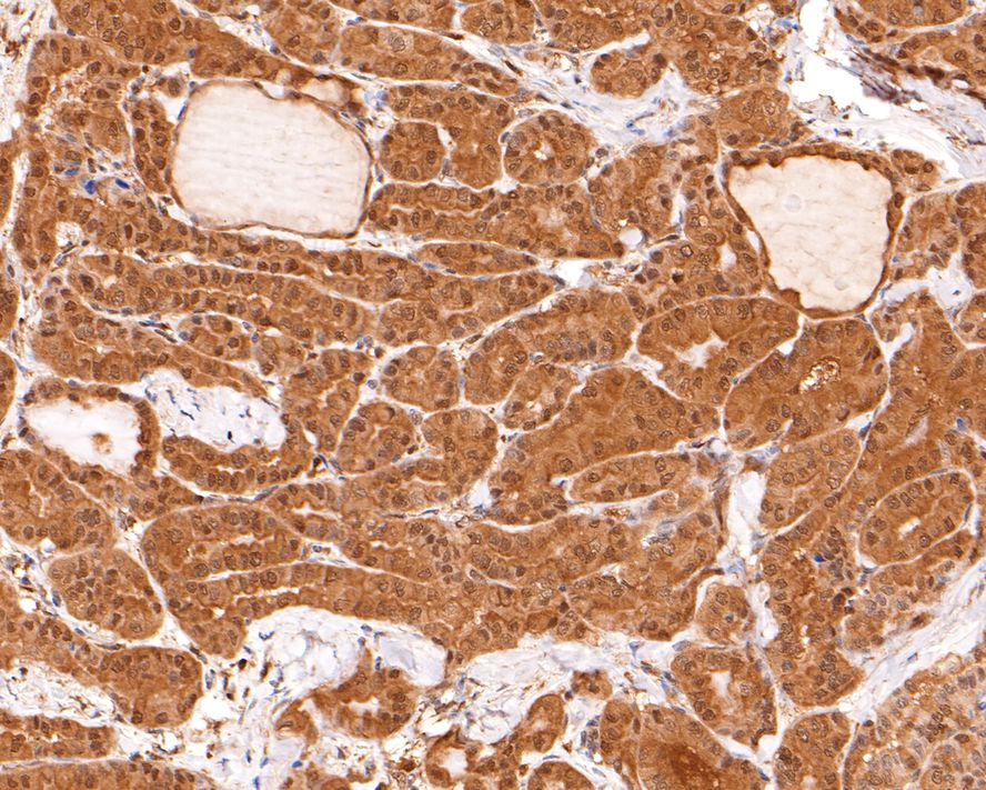Immunohistochemical analysis of paraffin-embedded human thyroid carcinoma tissue with Rabbit anti-Ube2L3 antibody (HA721005) at 1/400 dilution.<br />
<br />
The section was pre-treated using heat mediated antigen retrieval with sodium citrate buffer (pH 6.0) for 2 minutes. The tissues were blocked in 1% BSA for 20 minutes at room temperature, washed with ddH2O and PBS, and then probed with the primary antibody (HA721005) at 1/400 dilution for 1 hour at room temperature. The detection was performed using an HRP conjugated compact polymer system. DAB was used as the chromogen. Tissues were counterstained with hematoxylin and mounted with DPX.