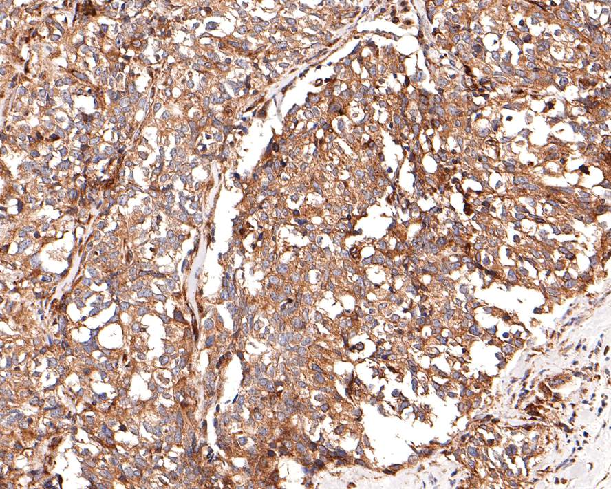 Immunohistochemical analysis of paraffin-embedded human breast carcinoma tissue with Rabbit anti-RAB5C antibody (HA721012) at 1/100 dilution.<br />
<br />
The section was pre-treated using heat mediated antigen retrieval with Tris-EDTA buffer (pH 9.0) for 20 minutes. The tissues were blocked in 1% BSA for 20 minutes at room temperature, washed with ddH2O and PBS, and then probed with the primary antibody (HA721012) at 1/100 dilution for 1 hour at room temperature. The detection was performed using an HRP conjugated compact polymer system. DAB was used as the chromogen. Tissues were counterstained with hematoxylin and mounted with DPX.