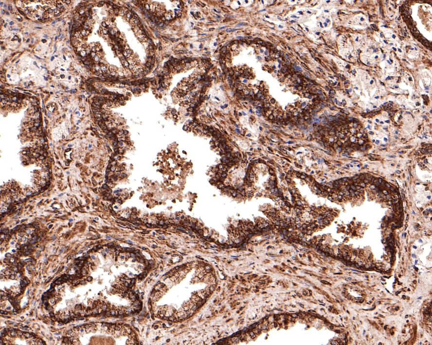 Immunohistochemical analysis of paraffin-embedded human prostate tissue with Rabbit anti-MST4 antibody (HA721094) at 1/400 dilution.<br />
<br />
The section was pre-treated using heat mediated antigen retrieval with Tris-EDTA buffer (pH 9.0) for 20 minutes. The tissues were blocked in 1% BSA for 20 minutes at room temperature, washed with ddH2O and PBS, and then probed with the primary antibody (HA721094) at 1/400 dilution for 1 hour at room temperature. The detection was performed using an HRP conjugated compact polymer system. DAB was used as the chromogen. Tissues were counterstained with hematoxylin and mounted with DPX.