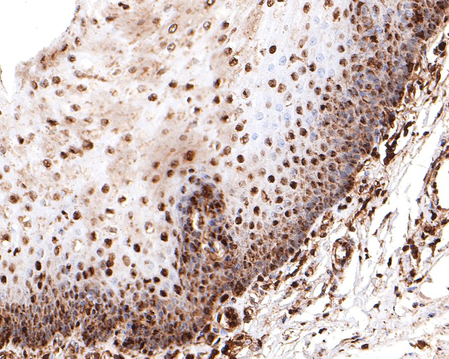 Immunohistochemical analysis of paraffin-embedded human esophagus tissue with Rabbit anti-PRPF31 antibody (HA721089) at 1/200 dilution.<br />
<br />
The section was pre-treated using heat mediated antigen retrieval with sodium citrate buffer (pH 6.0) for 2 minutes. The tissues were blocked in 1% BSA for 20 minutes at room temperature, washed with ddH2O and PBS, and then probed with the primary antibody (HA721089) at 1/200 dilution for 1 hour at room temperature. The detection was performed using an HRP conjugated compact polymer system. DAB was used as the chromogen. Tissues were counterstained with hematoxylin and mounted with DPX.