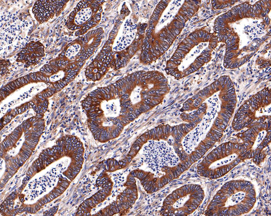 Immunohistochemical analysis of paraffin-embedded human colon carcinoma tissue with Rabbit anti-NSDHL antibody (HA721088) at 1/400 dilution.<br />
<br />
The section was pre-treated using heat mediated antigen retrieval with Tris-EDTA buffer (pH 9.0) for 20 minutes. The tissues were blocked in 1% BSA for 20 minutes at room temperature, washed with ddH2O and PBS, and then probed with the primary antibody (HA721088) at 1/400 dilution for 1 hour at room temperature. The detection was performed using an HRP conjugated compact polymer system. DAB was used as the chromogen. Tissues were counterstained with hematoxylin and mounted with DPX.