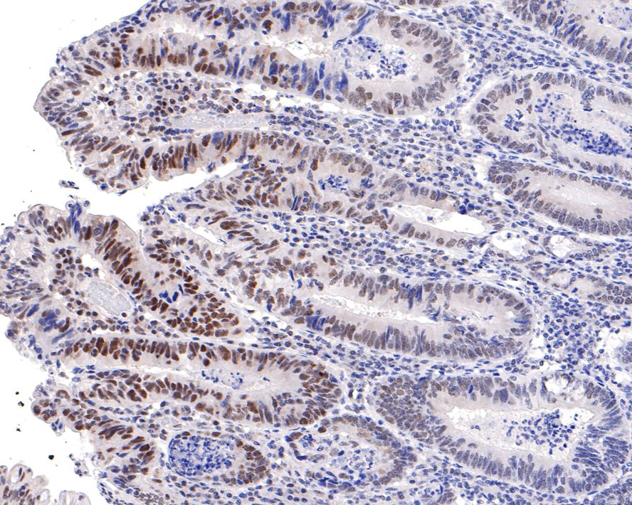Immunohistochemical analysis of paraffin-embedded human colon carcinoma tissue with Rabbit anti-PNKP antibody (HA721087) at 1/100 dilution.<br />
<br />
The section was pre-treated using heat mediated antigen retrieval with sodium citrate buffer (pH 6.0) for 2 minutes. The tissues were blocked in 1% BSA for 20 minutes at room temperature, washed with ddH2O and PBS, and then probed with the primary antibody (HA721087) at 1/100 dilution for 1 hour at room temperature. The detection was performed using an HRP conjugated compact polymer system. DAB was used as the chromogen. Tissues were counterstained with hematoxylin and mounted with DPX.