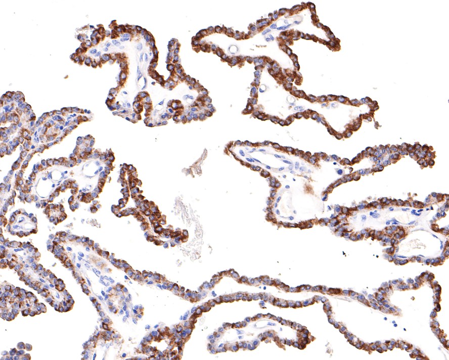 Immunohistochemical analysis of paraffin-embedded human thyroid carcinoma tissue with Rabbit anti-SNX5 antibody (HA721084) at 1/100 dilution.<br />
<br />
The section was pre-treated using heat mediated antigen retrieval with Tris-EDTA buffer (pH 9.0) for 20 minutes. The tissues were blocked in 1% BSA for 20 minutes at room temperature, washed with ddH2O and PBS, and then probed with the primary antibody (HA721084) at 1/100 dilution for 1 hour at room temperature. The detection was performed using an HRP conjugated compact polymer system. DAB was used as the chromogen. Tissues were counterstained with hematoxylin and mounted with DPX.