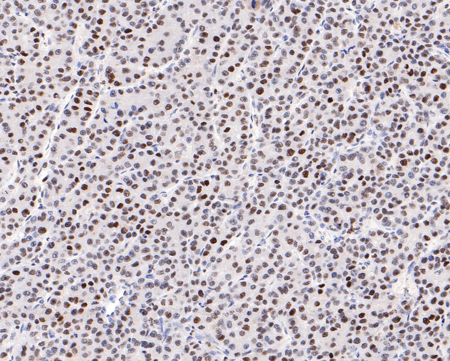 Immunohistochemical analysis of paraffin-embedded human liver carcinoma tissue with Rabbit anti-NUP50 antibody (HA721075) at 1/100 dilution.<br />
<br />
The section was pre-treated using heat mediated antigen retrieval with sodium citrate buffer (pH 6.0) for 2 minutes. The tissues were blocked in 1% BSA for 20 minutes at room temperature, washed with ddH2O and PBS, and then probed with the primary antibody (HA721075) at 1/100 dilution for 1 hour at room temperature. The detection was performed using an HRP conjugated compact polymer system. DAB was used as the chromogen. Tissues were counterstained with hematoxylin and mounted with DPX.