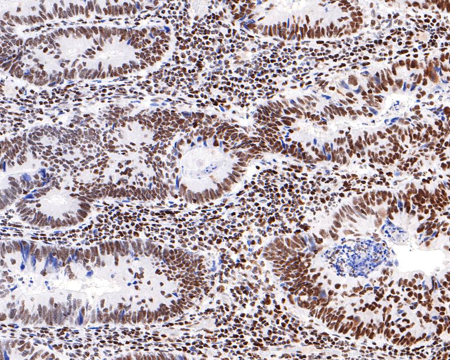 Immunohistochemical analysis of paraffin-embedded human colon carcinoma tissue with Rabbit anti-NUP50 antibody (HA721075) at 1/400 dilution.<br />
<br />
The section was pre-treated using heat mediated antigen retrieval with sodium citrate buffer (pH 6.0) for 2 minutes. The tissues were blocked in 1% BSA for 20 minutes at room temperature, washed with ddH2O and PBS, and then probed with the primary antibody (HA721075) at 1/400 dilution for 1 hour at room temperature. The detection was performed using an HRP conjugated compact polymer system. DAB was used as the chromogen. Tissues were counterstained with hematoxylin and mounted with DPX.
