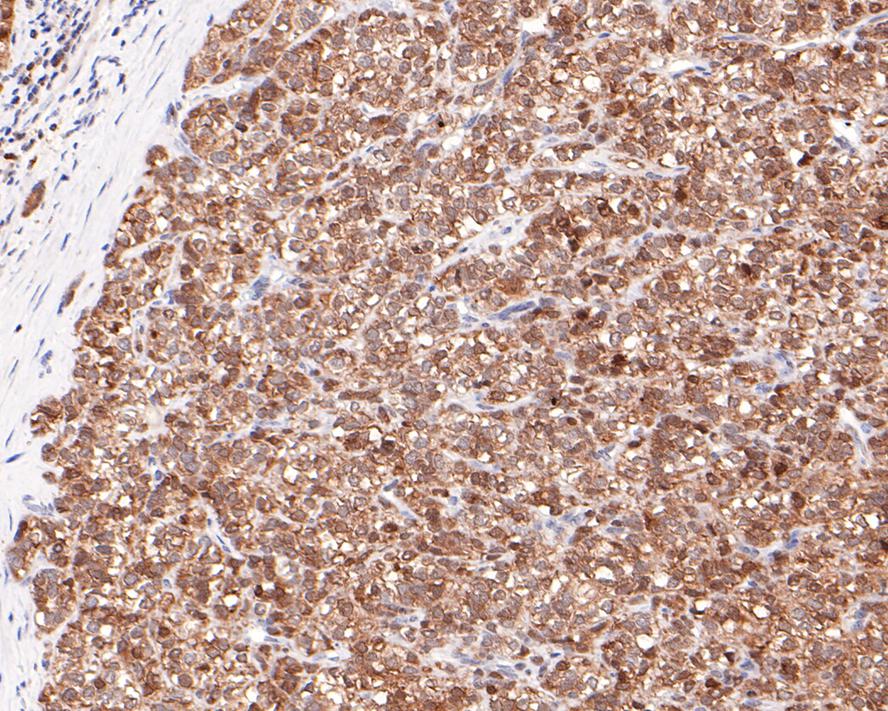 Immunohistochemical analysis of paraffin-embedded human liver carcinoma tissue with Rabbit anti-CRCP antibody (HA721062) at 1/100 dilution.<br />
<br />
The section was pre-treated using heat mediated antigen retrieval with sodium citrate buffer (pH 6.0) for 2 minutes. The tissues were blocked in 1% BSA for 20 minutes at room temperature, washed with ddH2O and PBS, and then probed with the primary antibody (HA721062) at 1/100 dilution for 1 hour at room temperature. The detection was performed using an HRP conjugated compact polymer system. DAB was used as the chromogen. Tissues were counterstained with hematoxylin and mounted with DPX.