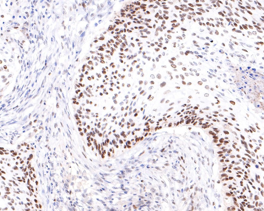 Immunohistochemical analysis of paraffin-embedded human cervical carcinoma tissue with Rabbit anti-PRPF4 antibody (HA721063) at 1/400 dilution.<br />
<br />
The section was pre-treated using heat mediated antigen retrieval with sodium citrate buffer (pH 6.0) for 2 minutes. The tissues were blocked in 1% BSA for 20 minutes at room temperature, washed with ddH2O and PBS, and then probed with the primary antibody (HA721063) at 1/400 dilution for 1 hour at room temperature. The detection was performed using an HRP conjugated compact polymer system. DAB was used as the chromogen. Tissues were counterstained with hematoxylin and mounted with DPX.