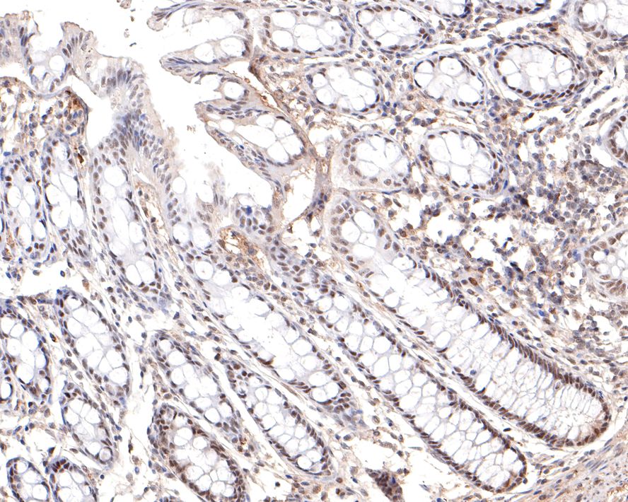 Immunohistochemical analysis of paraffin-embedded human colon tissue with Rabbit anti-PRPF4 antibody (HA721063) at 1/100 dilution.<br />
<br />
The section was pre-treated using heat mediated antigen retrieval with sodium citrate buffer (pH 6.0) for 2 minutes. The tissues were blocked in 1% BSA for 20 minutes at room temperature, washed with ddH2O and PBS, and then probed with the primary antibody (HA721063) at 1/100 dilution for 1 hour at room temperature. The detection was performed using an HRP conjugated compact polymer system. DAB was used as the chromogen. Tissues were counterstained with hematoxylin and mounted with DPX.