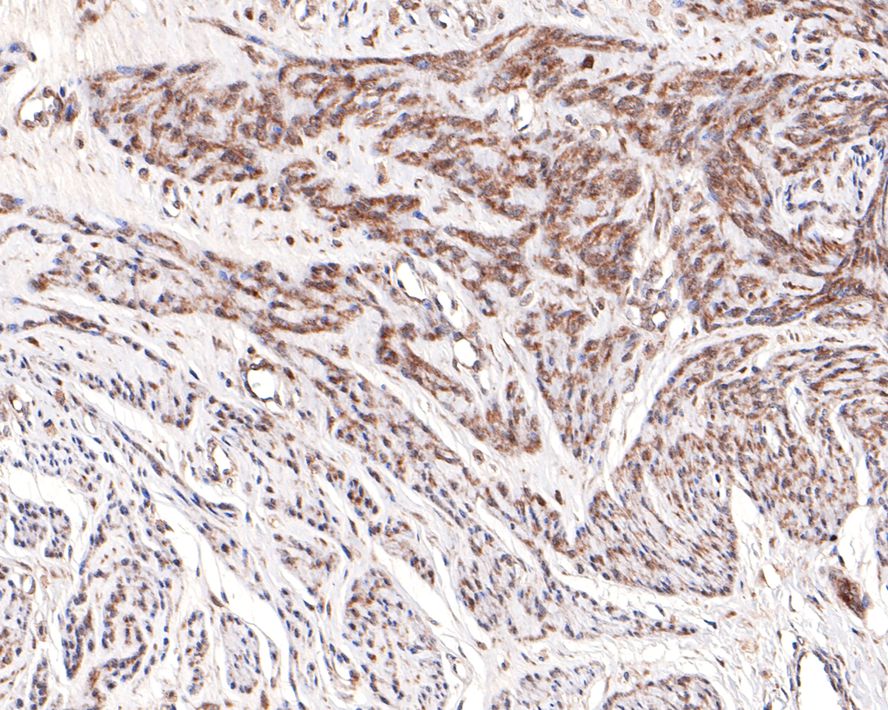 Immunohistochemical analysis of paraffin-embedded human cervix tissue with Rabbit anti-UFD1L antibody (HA721057) at 1/100 dilution.<br />
<br />
The section was pre-treated using heat mediated antigen retrieval with sodium citrate buffer (pH 6.0) for 2 minutes. The tissues were blocked in 1% BSA for 20 minutes at room temperature, washed with ddH2O and PBS, and then probed with the primary antibody (HA721057) at 1/100 dilution for 1 hour at room temperature. The detection was performed using an HRP conjugated compact polymer system. DAB was used as the chromogen. Tissues were counterstained with hematoxylin and mounted with DPX.