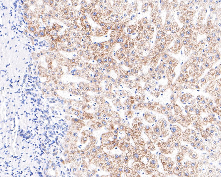 Immunohistochemical analysis of paraffin-embedded human colon carcinoma tissue with Rabbit anti-ACADS antibody (HA721058) at 1/100 dilution.<br />
<br />
The section was pre-treated using heat mediated antigen retrieval with Tris-EDTA buffer (pH 9.0) for 20 minutes. The tissues were blocked in 1% BSA for 20 minutes at room temperature, washed with ddH2O and PBS, and then probed with the primary antibody (HA721058) at 1/100 dilution for 1 hour at room temperature. The detection was performed using an HRP conjugated compact polymer system. DAB was used as the chromogen. Tissues were counterstained with hematoxylin and mounted with DPX.