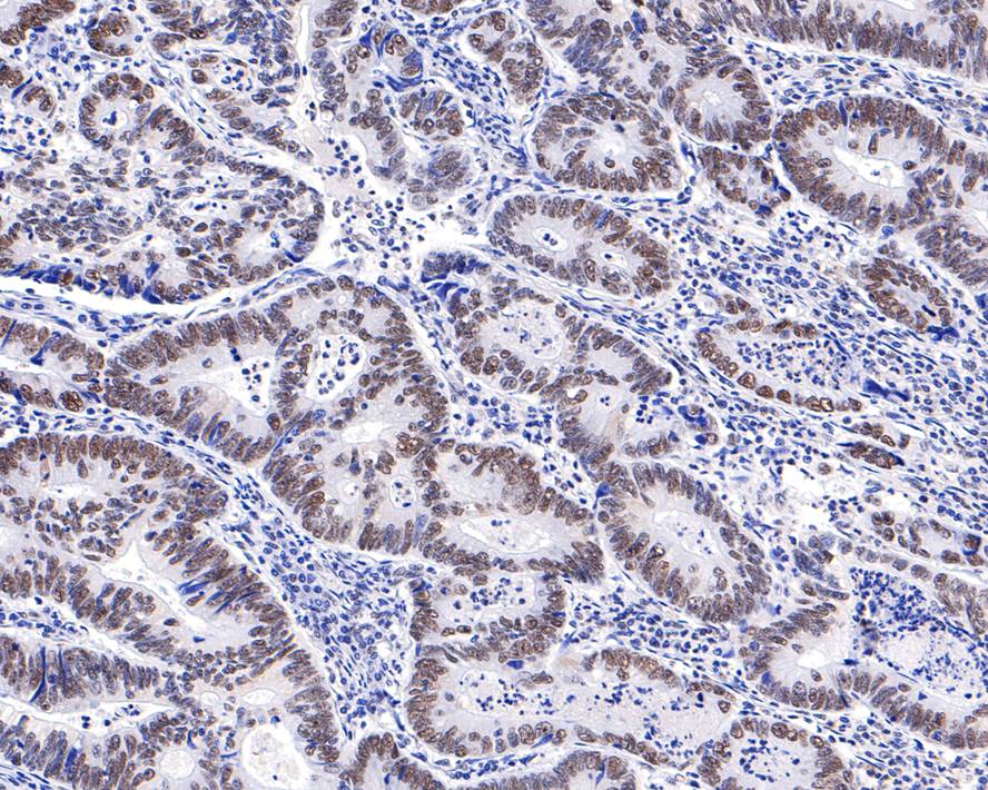 Immunohistochemical analysis of paraffin-embedded human colon carcinoma tissue with Rabbit anti-PPM1G antibody (HA721046) at 1/400 dilution.<br />
<br />
The section was pre-treated using heat mediated antigen retrieval with Tris-EDTA buffer (pH 9.0) for 20 minutes. The tissues were blocked in 1% BSA for 20 minutes at room temperature, washed with ddH2O and PBS, and then probed with the primary antibody (HA721046) at 1/400 dilution for 1 hour at room temperature. The detection was performed using an HRP conjugated compact polymer system. DAB was used as the chromogen. Tissues were counterstained with hematoxylin and mounted with DPX.