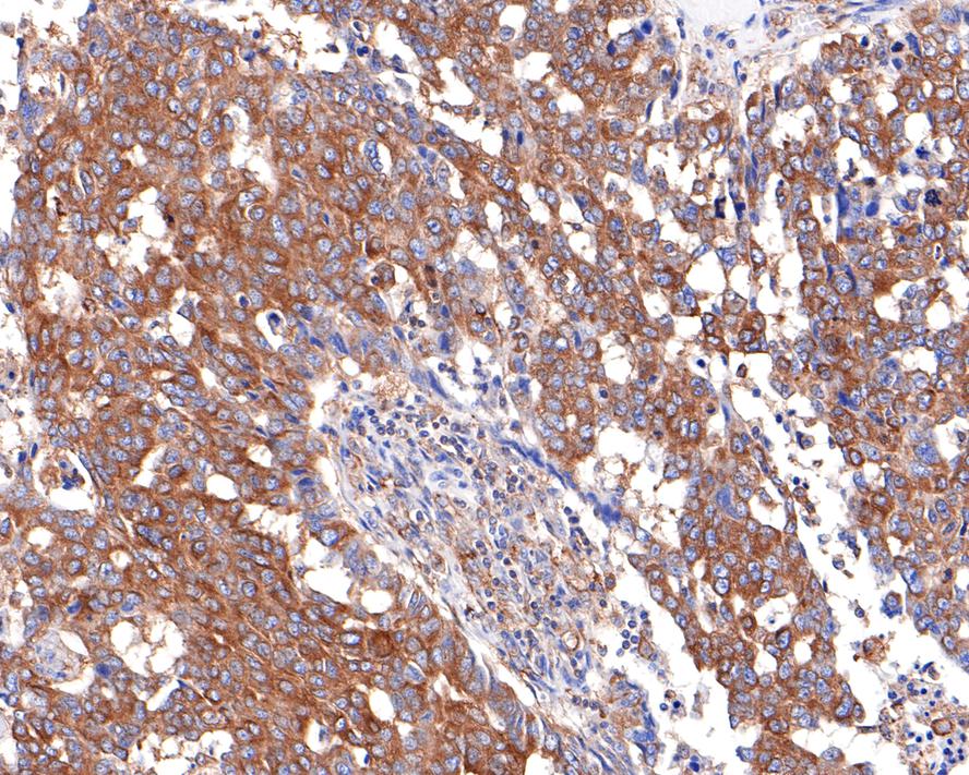 Immunohistochemical analysis of paraffin-embedded human ovarian carcinoma tissue with Rabbit anti-ACTR1B antibody (HA721050) at 1/400 dilution.<br />
<br />
The section was pre-treated using heat mediated antigen retrieval with Tris-EDTA buffer (pH 9.0) for 20 minutes. The tissues were blocked in 1% BSA for 20 minutes at room temperature, washed with ddH2O and PBS, and then probed with the primary antibody (HA721050) at 1/400 dilution for 1 hour at room temperature. The detection was performed using an HRP conjugated compact polymer system. DAB was used as the chromogen. Tissues were counterstained with hematoxylin and mounted with DPX.