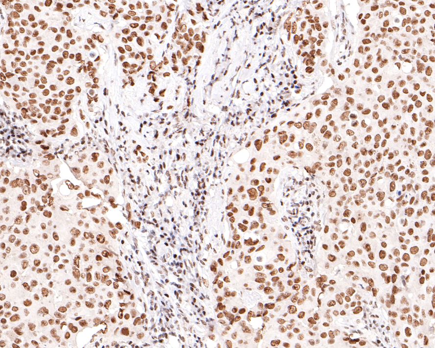 Immunohistochemical analysis of paraffin-embedded human breast carcinoma tissue with Rabbit anti-PNKP antibody (HA721044) at 1/400 dilution.<br />
<br />
The section was pre-treated using heat mediated antigen retrieval with sodium citrate buffer (pH 6.0) for 2 minutes. The tissues were blocked in 1% BSA for 20 minutes at room temperature, washed with ddH2O and PBS, and then probed with the primary antibody (HA721044) at 1/400 dilution for 1 hour at room temperature. The detection was performed using an HRP conjugated compact polymer system. DAB was used as the chromogen. Tissues were counterstained with hematoxylin and mounted with DPX.