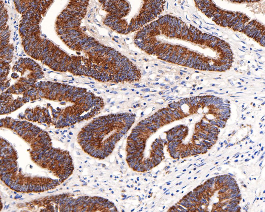 Immunohistochemical analysis of paraffin-embedded human colon carcinoma tissue with Rabbit anti-MDH2 antibody (HA721043) at 1/200 dilution.<br />
<br />
The section was pre-treated using heat mediated antigen retrieval with Tris-EDTA buffer (pH 9.0) for 20 minutes. The tissues were blocked in 1% BSA for 20 minutes at room temperature, washed with ddH2O and PBS, and then probed with the primary antibody (HA721043) at 1/200 dilution for 1 hour at room temperature. The detection was performed using an HRP conjugated compact polymer system. DAB was used as the chromogen. Tissues were counterstained with hematoxylin and mounted with DPX.