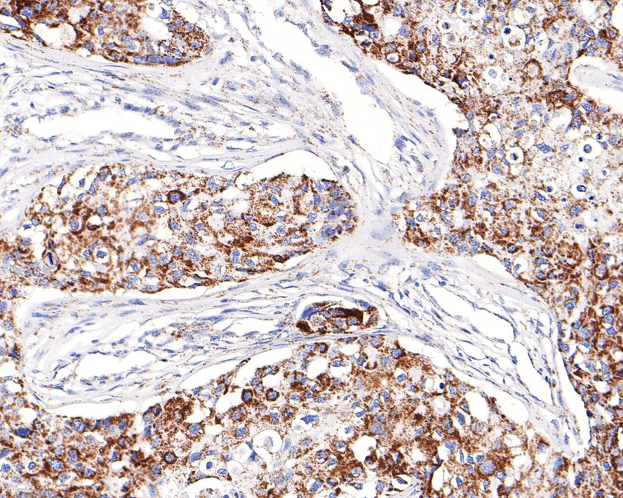 Immunohistochemical analysis of paraffin-embedded human breast carcinoma tissue with Rabbit anti-MDH2 antibody (HA721043) at 1/200 dilution.<br />
<br />
The section was pre-treated using heat mediated antigen retrieval with Tris-EDTA buffer (pH 9.0) for 20 minutes. The tissues were blocked in 1% BSA for 20 minutes at room temperature, washed with ddH2O and PBS, and then probed with the primary antibody (HA721043) at 1/200 dilution for 1 hour at room temperature. The detection was performed using an HRP conjugated compact polymer system. DAB was used as the chromogen. Tissues were counterstained with hematoxylin and mounted with DPX.