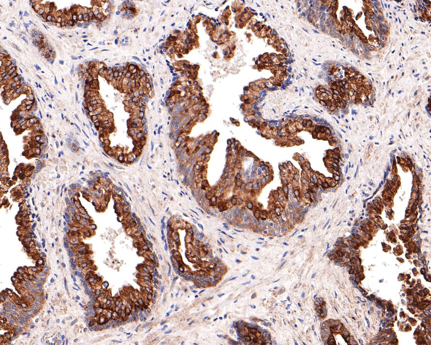 Immunohistochemical analysis of paraffin-embedded human prostate tissue with Rabbit anti-KCTD9 antibody (HA721042) at 1/400 dilution.<br />
<br />
The section was pre-treated using heat mediated antigen retrieval with Tris-EDTA buffer (pH 9.0) for 20 minutes. The tissues were blocked in 1% BSA for 20 minutes at room temperature, washed with ddH2O and PBS, and then probed with the primary antibody (HA721042) at 1/400 dilution for 1 hour at room temperature. The detection was performed using an HRP conjugated compact polymer system. DAB was used as the chromogen. Tissues were counterstained with hematoxylin and mounted with DPX.