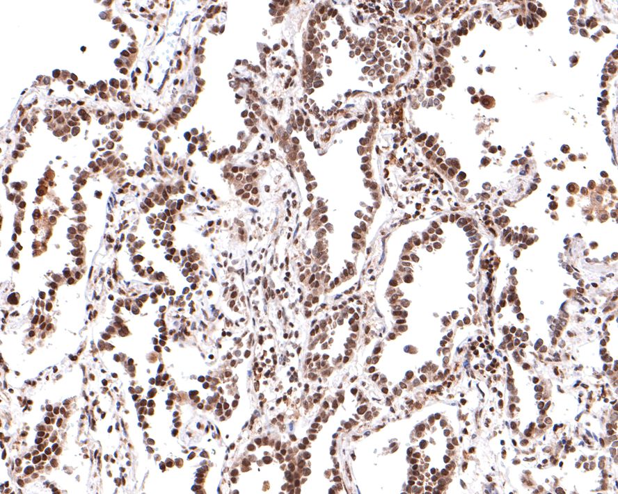 Immunohistochemical analysis of paraffin-embedded human lung carcinoma tissue with Rabbit anti-PER2 antibody (HA721036) at 1/400 dilution.<br />
<br />
The section was pre-treated using heat mediated antigen retrieval with sodium citrate buffer (pH 6.0) for 2 minutes. The tissues were blocked in 1% BSA for 20 minutes at room temperature, washed with ddH2O and PBS, and then probed with the primary antibody (HA721036) at 1/400 dilution for 1 hour at room temperature. The detection was performed using an HRP conjugated compact polymer system. DAB was used as the chromogen. Tissues were counterstained with hematoxylin and mounted with DPX.