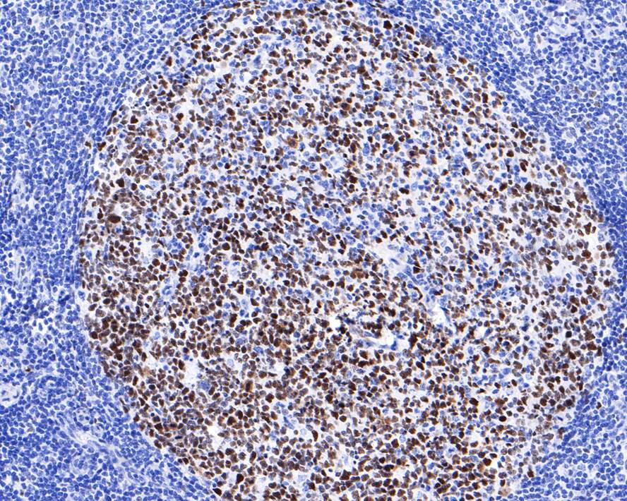 Immunohistochemical analysis of paraffin-embedded human lymph nodes tissue with Mouse anti-BCL6 antibody (HA600095) at 1/500 dilution.<br />
<br />
The section was pre-treated using heat mediated antigen retrieval with sodium citrate buffer (pH 6.0) for 2 minutes. The tissues were blocked in 1% BSA for 20 minutes at room temperature, washed with ddH2O and PBS, and then probed with the primary antibody (HA600095) at 1/500 dilution for 1 hour at room temperature. The detection was performed using an HRP conjugated compact polymer system. DAB was used as the chromogen. Tissues were counterstained with hematoxylin and mounted with DPX.