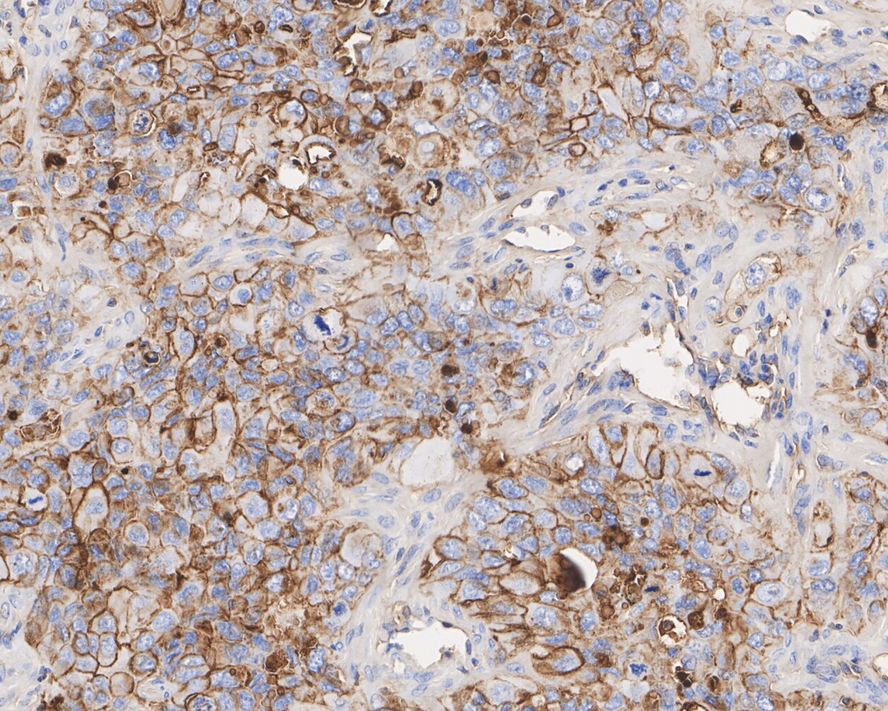 Immunohistochemical analysis of paraffin-embedded NCI-H441 xenograft tissue with Mouse anti-CD73 antibody (HA601004) at 1/600 dilution.<br />
<br />
The section was pre-treated using heat mediated antigen retrieval with Tris-EDTA buffer (pH 9.0) for 20 minutes. The tissues were blocked in 1% BSA for 20 minutes at room temperature, washed with ddH2O and PBS, and then probed with the primary antibody (HA601004) at 1/600 dilution for 1 hour at room temperature. The detection was performed using an HRP conjugated compact polymer system. DAB was used as the chromogen. Tissues were counterstained with hematoxylin and mounted with DPX.