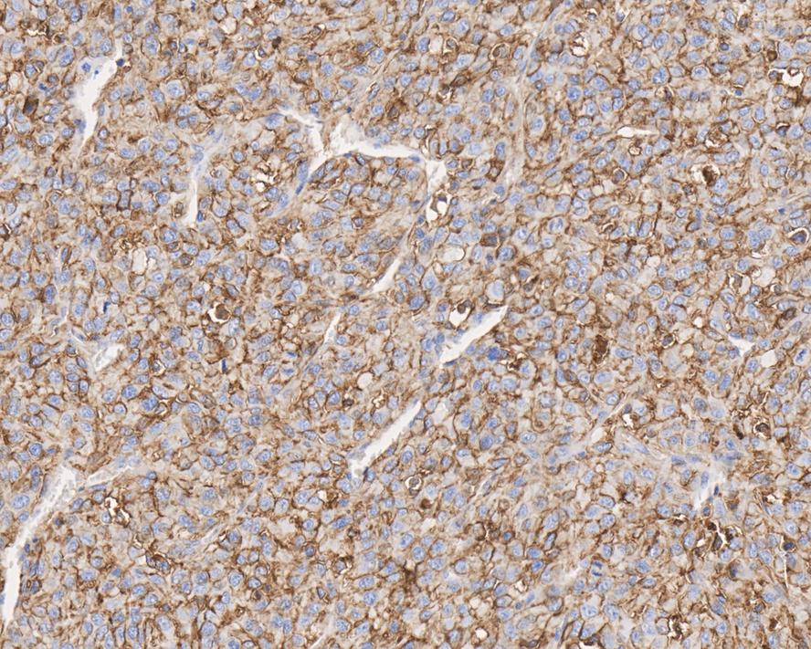Immunohistochemical analysis of paraffin-embedded U87MG xenograft tissue with Mouse anti-CD73 antibody (HA601004) at 1/200 dilution.<br />
<br />
The section was pre-treated using heat mediated antigen retrieval with Tris-EDTA buffer (pH 9.0) for 20 minutes. The tissues were blocked in 1% BSA for 20 minutes at room temperature, washed with ddH2O and PBS, and then probed with the primary antibody (HA601004) at 1/200 dilution for 1 hour at room temperature. The detection was performed using an HRP conjugated compact polymer system. DAB was used as the chromogen. Tissues were counterstained with hematoxylin and mounted with DPX.