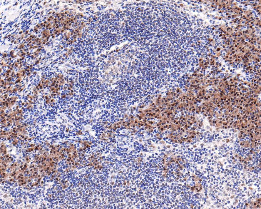 Immunohistochemical analysis of paraffin-embedded human lymph nodes tissue with Rabbit anti-PREB antibody (HA721125) at 1/400 dilution.<br />
<br />
The section was pre-treated using heat mediated antigen retrieval with sodium citrate buffer (pH 6.0) for 2 minutes. The tissues were blocked in 1% BSA for 20 minutes at room temperature, washed with ddH2O and PBS, and then probed with the primary antibody (HA721125) at 1/400 dilution for 1 hour at room temperature. The detection was performed using an HRP conjugated compact polymer system. DAB was used as the chromogen. Tissues were counterstained with hematoxylin and mounted with DPX.