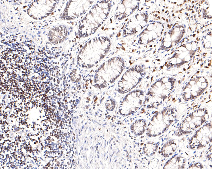 Immunohistochemical analysis of paraffin-embedded human colon tissue with Rabbit anti-PREB antibody (HA721125) at 1/100 dilution.<br />
<br />
The section was pre-treated using heat mediated antigen retrieval with sodium citrate buffer (pH 6.0) for 2 minutes. The tissues were blocked in 1% BSA for 20 minutes at room temperature, washed with ddH2O and PBS, and then probed with the primary antibody (HA721125) at 1/100 dilution for 1 hour at room temperature. The detection was performed using an HRP conjugated compact polymer system. DAB was used as the chromogen. Tissues were counterstained with hematoxylin and mounted with DPX.
