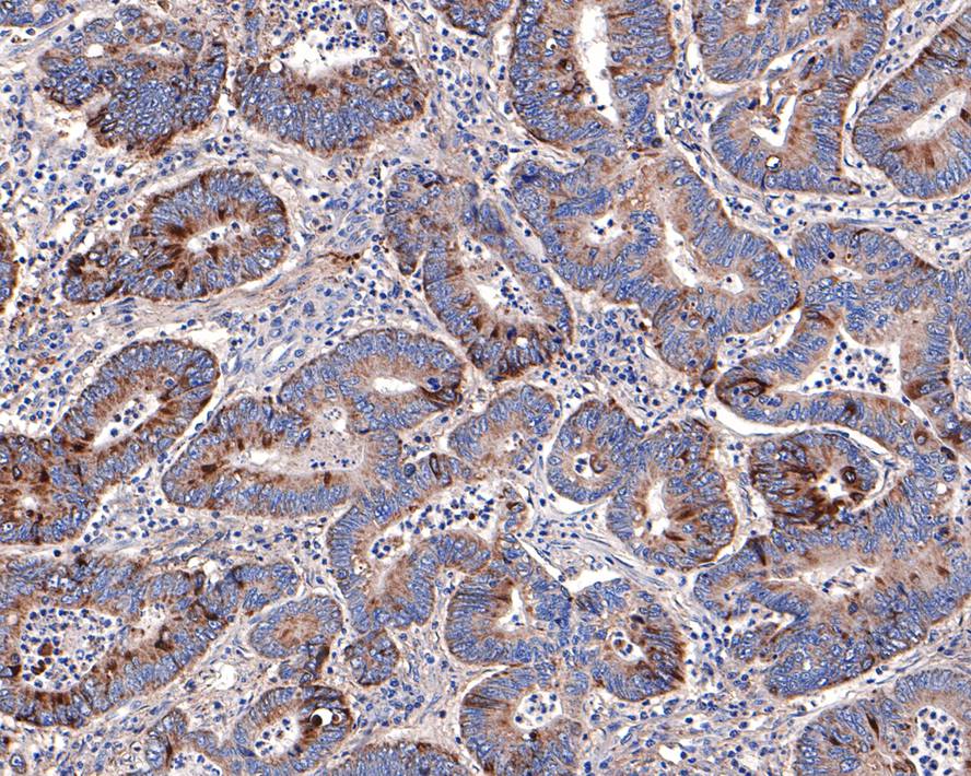 Immunohistochemical analysis of paraffin-embedded human pancreas tissue with Rabbit anti-ANXA7 antibody (HA721068) at 1/400 dilution.<br />
<br />
The section was pre-treated using heat mediated antigen retrieval with Tris-EDTA buffer (pH 9.0) for 20 minutes. The tissues were blocked in 1% BSA for 20 minutes at room temperature, washed with ddH2O and PBS, and then probed with the primary antibody (HA721068) at 1/400 dilution for 1 hour at room temperature. The detection was performed using an HRP conjugated compact polymer system. DAB was used as the chromogen. Tissues were counterstained with hematoxylin and mounted with DPX.