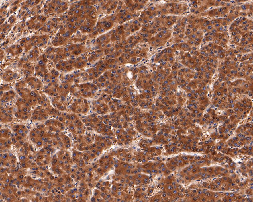Immunohistochemical analysis of paraffin-embedded human lung carcinoma tissue with Rabbit anti-PEX11B antibody (HA721124) at 1/400 dilution.<br />
<br />
The section was pre-treated using heat mediated antigen retrieval with Tris-EDTA buffer (pH 9.0) for 20 minutes. The tissues were blocked in 1% BSA for 20 minutes at room temperature, washed with ddH2O and PBS, and then probed with the primary antibody (HA721124) at 1/400 dilution for 1 hour at room temperature. The detection was performed using an HRP conjugated compact polymer system. DAB was used as the chromogen. Tissues were counterstained with hematoxylin and mounted with DPX.