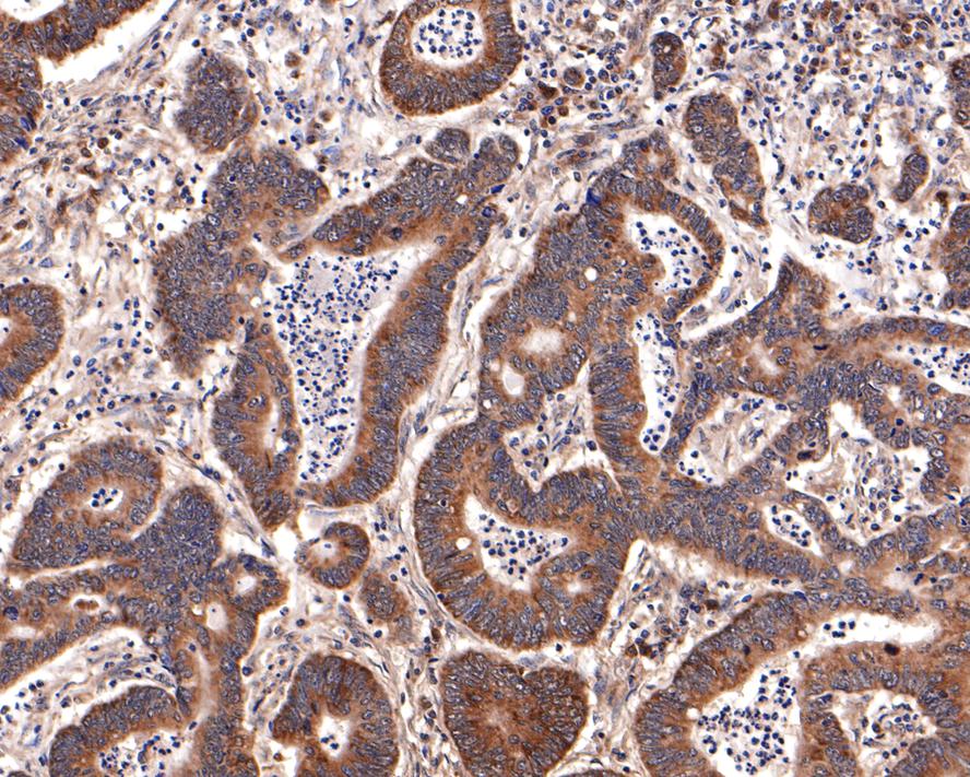 Immunohistochemical analysis of paraffin-embedded human colon carcinoma tissue with Rabbit anti-PEX11B antibody (HA721124) at 1/400 dilution.<br />
<br />
The section was pre-treated using heat mediated antigen retrieval with Tris-EDTA buffer (pH 9.0) for 20 minutes. The tissues were blocked in 1% BSA for 20 minutes at room temperature, washed with ddH2O and PBS, and then probed with the primary antibody (HA721124) at 1/400 dilution for 1 hour at room temperature. The detection was performed using an HRP conjugated compact polymer system. DAB was used as the chromogen. Tissues were counterstained with hematoxylin and mounted with DPX.