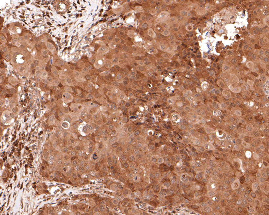 Immunohistochemical analysis of paraffin-embedded human breast carcinoma tissue with Rabbit anti-PEX11B antibody (HA721124) at 1/400 dilution.<br />
<br />
The section was pre-treated using heat mediated antigen retrieval with Tris-EDTA buffer (pH 9.0) for 20 minutes. The tissues were blocked in 1% BSA for 20 minutes at room temperature, washed with ddH2O and PBS, and then probed with the primary antibody (HA721124) at 1/400 dilution for 1 hour at room temperature. The detection was performed using an HRP conjugated compact polymer system. DAB was used as the chromogen. Tissues were counterstained with hematoxylin and mounted with DPX.