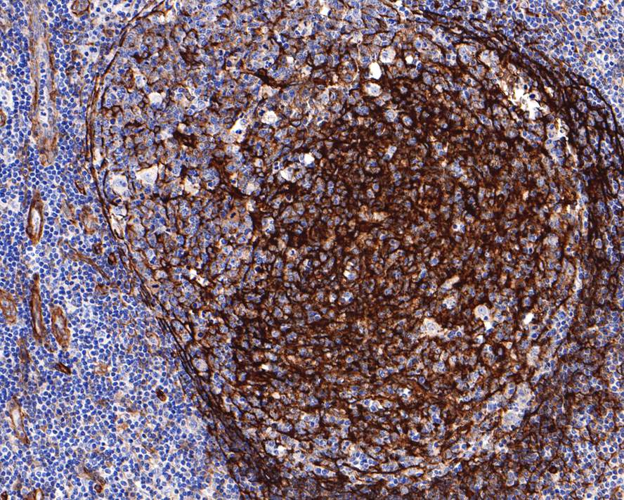 Immunohistochemical analysis of paraffin-embedded human lymph nodes tissue with Rabbit anti-MYO1B antibody (HA721119) at 1/400 dilution.<br />
<br />
The section was pre-treated using heat mediated antigen retrieval with Tris-EDTA buffer (pH 9.0) for 20 minutes. The tissues were blocked in 1% BSA for 20 minutes at room temperature, washed with ddH2O and PBS, and then probed with the primary antibody (HA721119) at 1/400 dilution for 1 hour at room temperature. The detection was performed using an HRP conjugated compact polymer system. DAB was used as the chromogen. Tissues were counterstained with hematoxylin and mounted with DPX.
