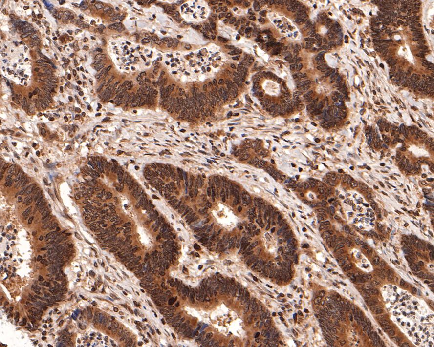 Immunohistochemical analysis of paraffin-embedded human colon carcinoma tissue with Rabbit anti-PIN4 antibody (HA721121) at 1/2,000 dilution.<br />
<br />
The section was pre-treated using heat mediated antigen retrieval with sodium citrate buffer (pH 6.0) for 2 minutes. The tissues were blocked in 1% BSA for 20 minutes at room temperature, washed with ddH2O and PBS, and then probed with the primary antibody (HA721121) at 1/2,000 dilution for 1 hour at room temperature. The detection was performed using an HRP conjugated compact polymer system. DAB was used as the chromogen. Tissues were counterstained with hematoxylin and mounted with DPX.