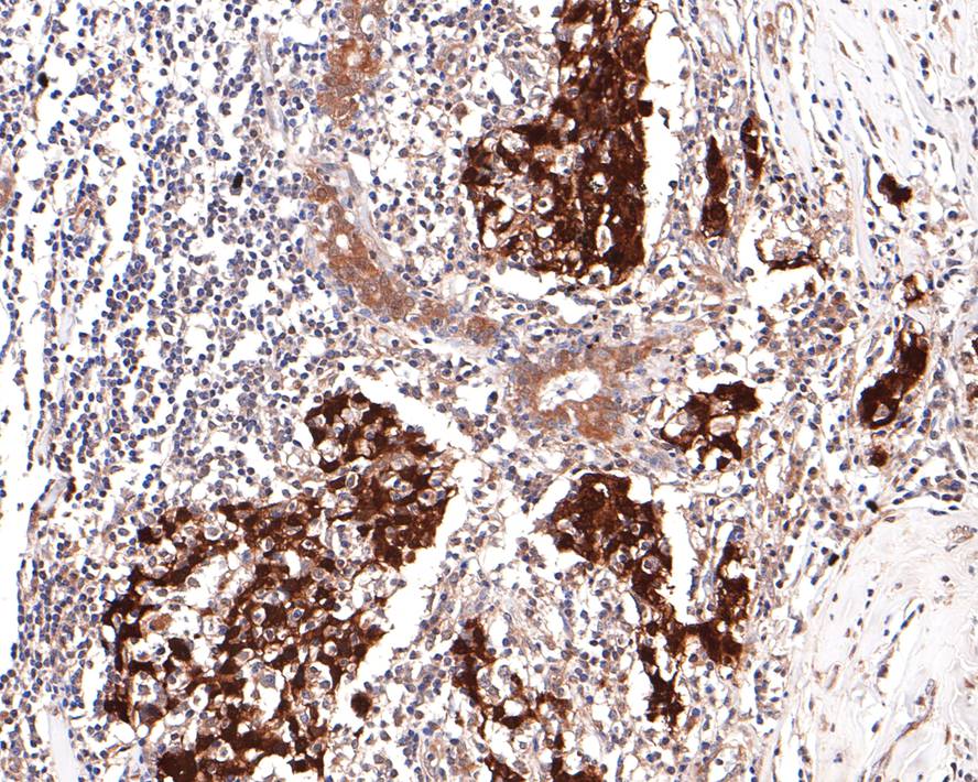 Immunohistochemical analysis of paraffin-embedded human breast carcinoma tissue with Rabbit anti-UFC1 antibody (HA721111) at 1/400 dilution.<br />
<br />
The section was pre-treated using heat mediated antigen retrieval with Tris-EDTA buffer (pH 9.0) for 20 minutes. The tissues were blocked in 1% BSA for 20 minutes at room temperature, washed with ddH2O and PBS, and then probed with the primary antibody (HA721111) at 1/400 dilution for 1 hour at room temperature. The detection was performed using an HRP conjugated compact polymer system. DAB was used as the chromogen. Tissues were counterstained with hematoxylin and mounted with DPX.