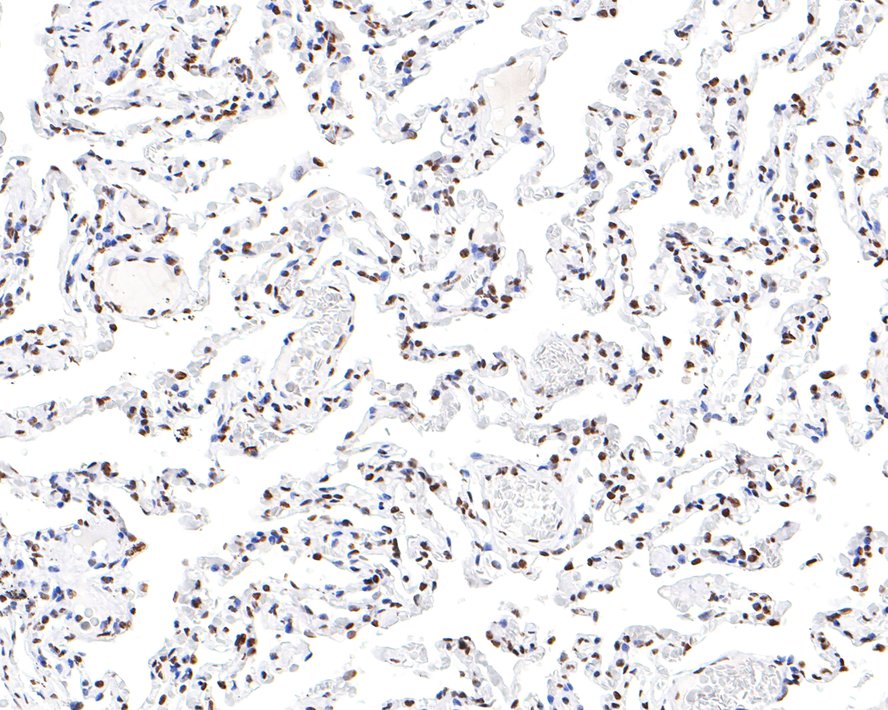 Immunohistochemical analysis of paraffin-embedded human lung tissue with Rabbit anti-HNRNPM antibody (HA721103) at 1/200 dilution.<br />
<br />
The section was pre-treated using heat mediated antigen retrieval with sodium citrate buffer (pH 6.0) for 2 minutes. The tissues were blocked in 1% BSA for 20 minutes at room temperature, washed with ddH2O and PBS, and then probed with the primary antibody (HA721103) at 1/200 dilution for 1 hour at room temperature. The detection was performed using an HRP conjugated compact polymer system. DAB was used as the chromogen. Tissues were counterstained with hematoxylin and mounted with DPX.