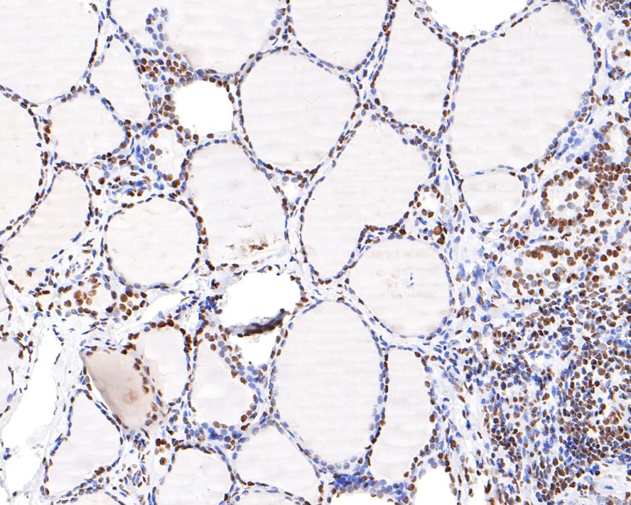 Immunohistochemical analysis of paraffin-embedded human thyroid tissue with Rabbit anti-HNRNPM antibody (HA721103) at 1/200 dilution.<br />
<br />
The section was pre-treated using heat mediated antigen retrieval with sodium citrate buffer (pH 6.0) for 2 minutes. The tissues were blocked in 1% BSA for 20 minutes at room temperature, washed with ddH2O and PBS, and then probed with the primary antibody (HA721103) at 1/200 dilution for 1 hour at room temperature. The detection was performed using an HRP conjugated compact polymer system. DAB was used as the chromogen. Tissues were counterstained with hematoxylin and mounted with DPX.