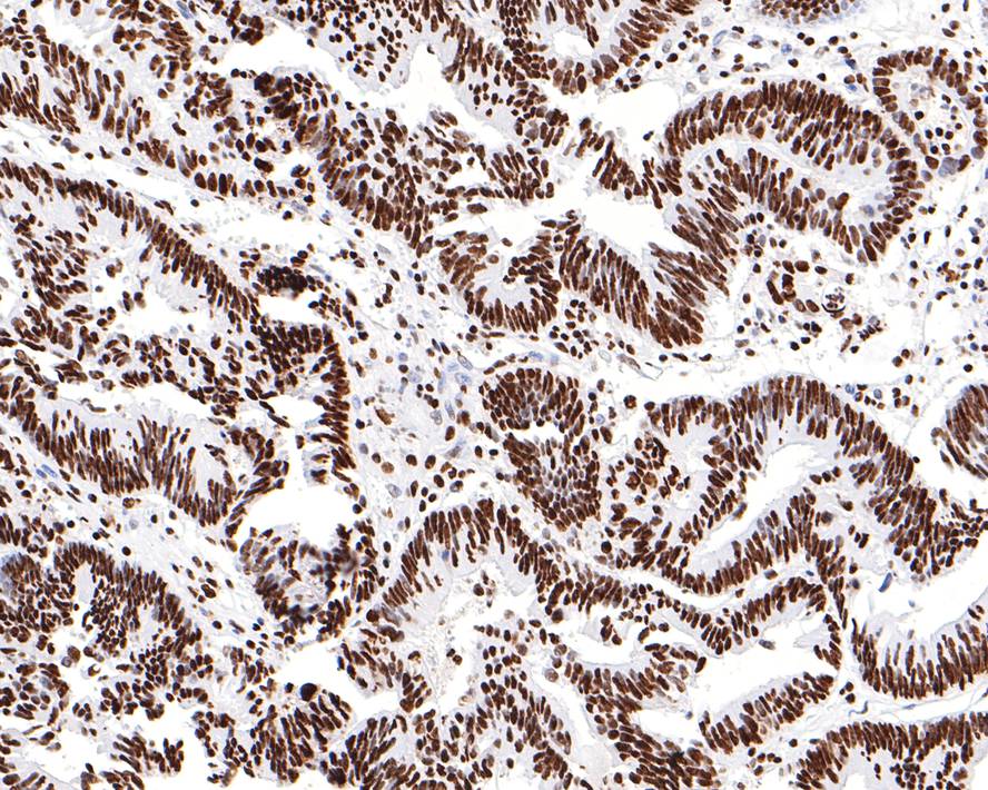 Immunohistochemical analysis of paraffin-embedded human colon carcinoma tissue with Rabbit anti-HNRNPM antibody (HA721103) at 1/200 dilution.<br />
<br />
The section was pre-treated using heat mediated antigen retrieval with sodium citrate buffer (pH 6.0) for 2 minutes. The tissues were blocked in 1% BSA for 20 minutes at room temperature, washed with ddH2O and PBS, and then probed with the primary antibody (HA721103) at 1/200 dilution for 1 hour at room temperature. The detection was performed using an HRP conjugated compact polymer system. DAB was used as the chromogen. Tissues were counterstained with hematoxylin and mounted with DPX.
