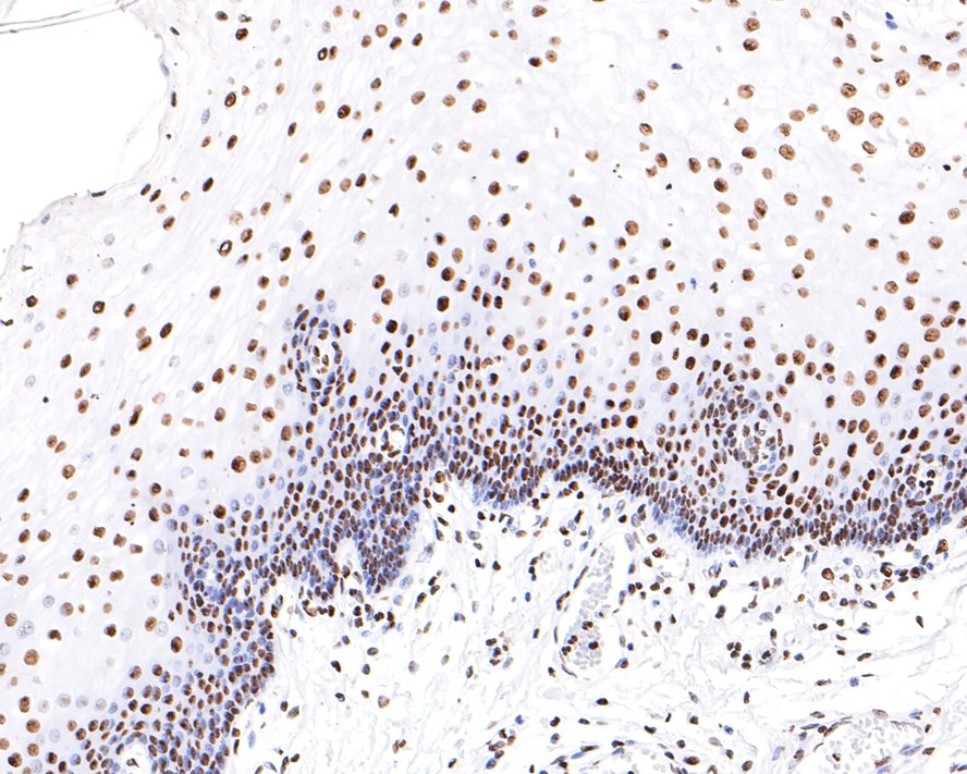 Immunohistochemical analysis of paraffin-embedded human esophagus tissue with Rabbit anti-HNRNPM antibody (HA721103) at 1/200 dilution.<br />
<br />
The section was pre-treated using heat mediated antigen retrieval with sodium citrate buffer (pH 6.0) for 2 minutes. The tissues were blocked in 1% BSA for 20 minutes at room temperature, washed with ddH2O and PBS, and then probed with the primary antibody (HA721103) at 1/200 dilution for 1 hour at room temperature. The detection was performed using an HRP conjugated compact polymer system. DAB was used as the chromogen. Tissues were counterstained with hematoxylin and mounted with DPX.
