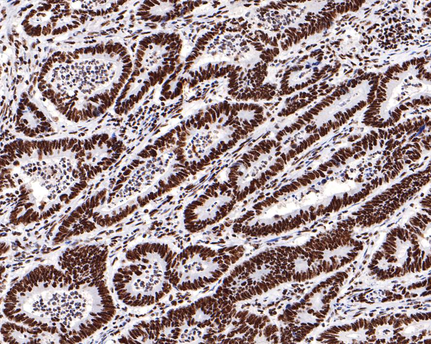 Immunohistochemical analysis of paraffin-embedded human colon carcinoma tissue with Rabbit anti-SF3A3 antibody (HA721114) at 1/400 dilution.<br />
<br />
The section was pre-treated using heat mediated antigen retrieval with sodium citrate buffer (pH 6.0) for 2 minutes. The tissues were blocked in 1% BSA for 20 minutes at room temperature, washed with ddH2O and PBS, and then probed with the primary antibody (HA721114) at 1/400 dilution for 1 hour at room temperature. The detection was performed using an HRP conjugated compact polymer system. DAB was used as the chromogen. Tissues were counterstained with hematoxylin and mounted with DPX.