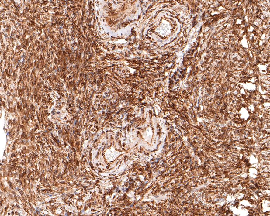 Immunohistochemical analysis of paraffin-embedded human ovary tissue with Rabbit anti-TMEM43 antibody (HA721083) at 1/400 dilution.<br />
<br />
The section was pre-treated using heat mediated antigen retrieval with sodium citrate buffer (pH 6.0) for 2 minutes. The tissues were blocked in 1% BSA for 20 minutes at room temperature, washed with ddH2O and PBS, and then probed with the primary antibody (HA721083) at 1/400 dilution for 1 hour at room temperature. The detection was performed using an HRP conjugated compact polymer system. DAB was used as the chromogen. Tissues were counterstained with hematoxylin and mounted with DPX.