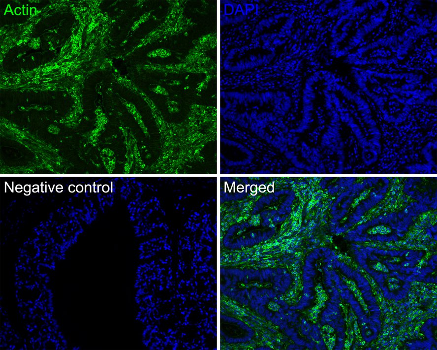Immunofluorescence analysis of paraffin-embedded human colon carcinoma tissue labeling Actin (HA720160F).<br />
<br />
The section was pre-treated using heat mediated antigen retrieval with Tris-EDTA buffer (pH 9.0) for 20 minutes. The tissues were blocked in 10% negative goat serum for 1 hour at room temperature, washed with PBS. And then probed with the primary antibody Actin (HA720160F, iFluor™ 488) at 1/50 dilution overnight at 4 ℃, washed with PBS. DAPI was used as nuclear counterstain.