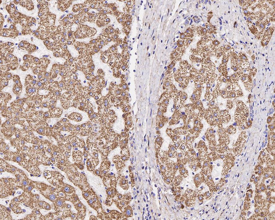 Immunohistochemical analysis of paraffin-embedded human liver carcinoma tissue with Rabbit anti-ACAT1 antibody (HA721093) at 1/200 dilution.<br />
<br />
The section was pre-treated using heat mediated antigen retrieval with Tris-EDTA buffer (pH 9.0) for 20 minutes. The tissues were blocked in 1% BSA for 20 minutes at room temperature, washed with ddH2O and PBS, and then probed with the primary antibody (HA721093) at 1/200 dilution for 1 hour at room temperature. The detection was performed using an HRP conjugated compact polymer system. DAB was used as the chromogen. Tissues were counterstained with hematoxylin and mounted with DPX.