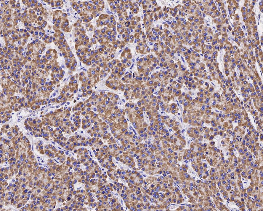 Immunohistochemical analysis of paraffin-embedded rat liver tissue with Rabbit anti-ACAT1 antibody (HA721093) at 1/100 dilution.<br />
<br />
The section was pre-treated using heat mediated antigen retrieval with Tris-EDTA buffer (pH 9.0) for 20 minutes. The tissues were blocked in 1% BSA for 20 minutes at room temperature, washed with ddH2O and PBS, and then probed with the primary antibody (HA721093) at 1/100 dilution for 1 hour at room temperature. The detection was performed using an HRP conjugated compact polymer system. DAB was used as the chromogen. Tissues were counterstained with hematoxylin and mounted with DPX.