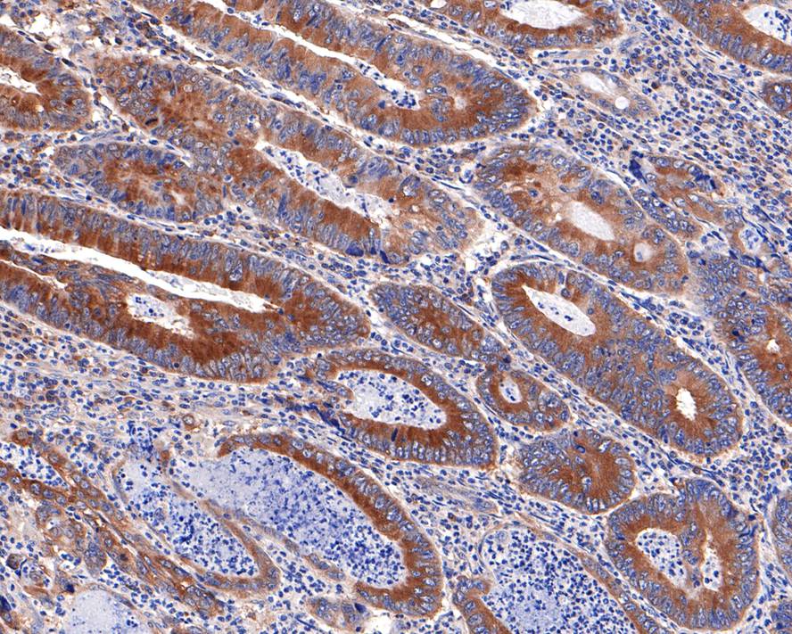 Immunohistochemical analysis of paraffin-embedded human colon carcinoma tissue with Rabbit anti-eIF1A antibody (HA721099) at 1/400 dilution.<br />
<br />
The section was pre-treated using heat mediated antigen retrieval with Tris-EDTA buffer (pH 9.0) for 20 minutes. The tissues were blocked in 1% BSA for 20 minutes at room temperature, washed with ddH2O and PBS, and then probed with the primary antibody (HA721099) at 1/400 dilution for 1 hour at room temperature. The detection was performed using an HRP conjugated compact polymer system. DAB was used as the chromogen. Tissues were counterstained with hematoxylin and mounted with DPX.