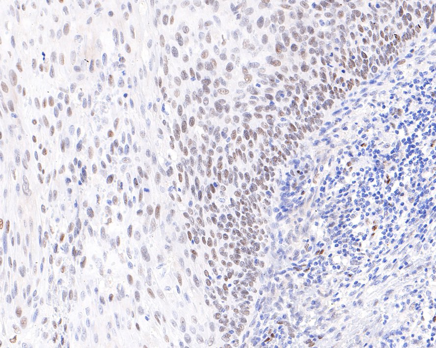 Immunohistochemical analysis of paraffin-embedded human cervix carcinoma tissue with Rabbit anti-RAVER2 antibody (HA721100) at 1/400 dilution.<br />
<br />
The section was pre-treated using heat mediated antigen retrieval with sodium citrate buffer (pH 6.0) for 2 minutes. The tissues were blocked in 1% BSA for 20 minutes at room temperature, washed with ddH2O and PBS, and then probed with the primary antibody (HA721100) at 1/400 dilution for 1 hour at room temperature. The detection was performed using an HRP conjugated compact polymer system. DAB was used as the chromogen. Tissues were counterstained with hematoxylin and mounted with DPX.