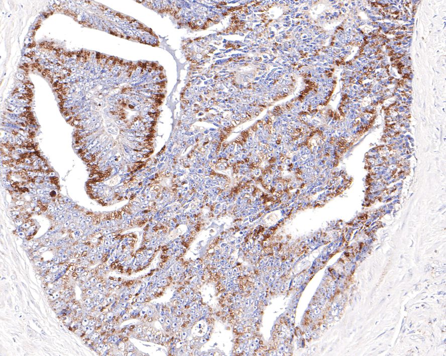 Immunohistochemical analysis of paraffin-embedded human prostate carcinoma tissue with Rabbit anti-TMEM192 antibody (HA721106) at 1/100 dilution.<br />
<br />
The section was pre-treated using heat mediated antigen retrieval with Tris-EDTA buffer (pH 9.0) for 20 minutes. The tissues were blocked in 1% BSA for 20 minutes at room temperature, washed with ddH2O and PBS, and then probed with the primary antibody (HA721106) at 1/100 dilution for 1 hour at room temperature. The detection was performed using an HRP conjugated compact polymer system. DAB was used as the chromogen. Tissues were counterstained with hematoxylin and mounted with DPX.