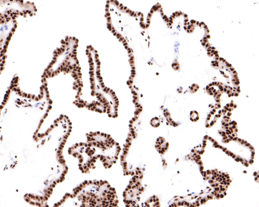 Immunohistochemical analysis of paraffin-embedded human thyroid carcinoma tissue with Rabbit anti-TAF3 antibody (HA721107) at 1/400 dilution.<br />
<br />
The section was pre-treated using heat mediated antigen retrieval with sodium citrate buffer (pH 6.0) for 2 minutes. The tissues were blocked in 1% BSA for 20 minutes at room temperature, washed with ddH2O and PBS, and then probed with the primary antibody (HA721107) at 1/400 dilution for 1 hour at room temperature. The detection was performed using an HRP conjugated compact polymer system. DAB was used as the chromogen. Tissues were counterstained with hematoxylin and mounted with DPX.