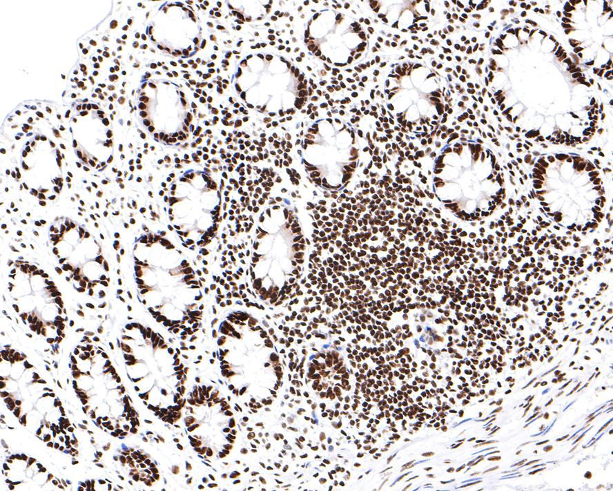 Immunohistochemical analysis of paraffin-embedded human colon tissue with Rabbit anti-TAF3 antibody (HA721107) at 1/400 dilution.<br />
<br />
The section was pre-treated using heat mediated antigen retrieval with sodium citrate buffer (pH 6.0) for 2 minutes. The tissues were blocked in 1% BSA for 20 minutes at room temperature, washed with ddH2O and PBS, and then probed with the primary antibody (HA721107) at 1/400 dilution for 1 hour at room temperature. The detection was performed using an HRP conjugated compact polymer system. DAB was used as the chromogen. Tissues were counterstained with hematoxylin and mounted with DPX.