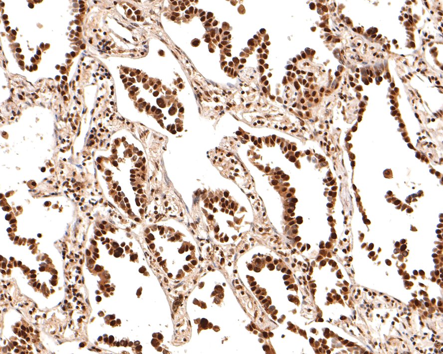 Immunohistochemical analysis of paraffin-embedded human lung carcinoma tissue with Rabbit anti-TCEA1 antibody (HA721086) at 1/2,000 dilution.<br />
<br />
The section was pre-treated using heat mediated antigen retrieval with sodium citrate buffer (pH 6.0) for 2 minutes. The tissues were blocked in 1% BSA for 20 minutes at room temperature, washed with ddH2O and PBS, and then probed with the primary antibody (HA721086) at 1/2,000 dilution for 1 hour at room temperature. The detection was performed using an HRP conjugated compact polymer system. DAB was used as the chromogen. Tissues were counterstained with hematoxylin and mounted with DPX.